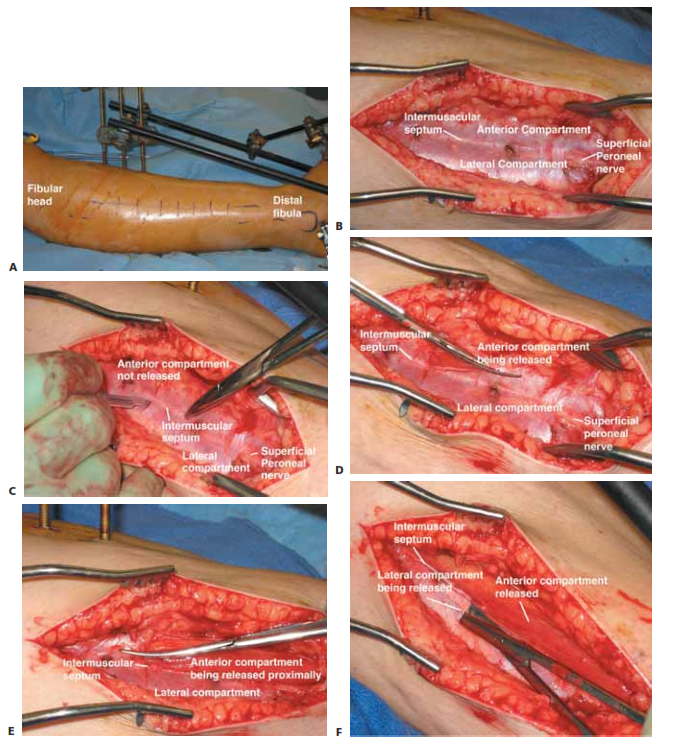 Illustration 1 for Acute Compartment Syndrome Fasciotomy: Urgent Surgical Guide