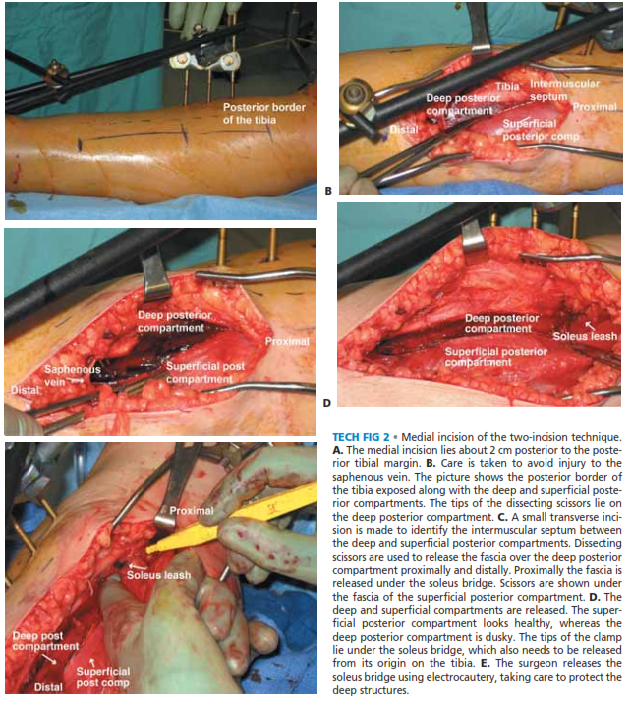 Illustration 2 for Acute Compartment Syndrome Fasciotomy: Urgent Surgical Guide