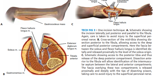 Illustration 3 for Acute Compartment Syndrome Fasciotomy: Urgent Surgical Guide