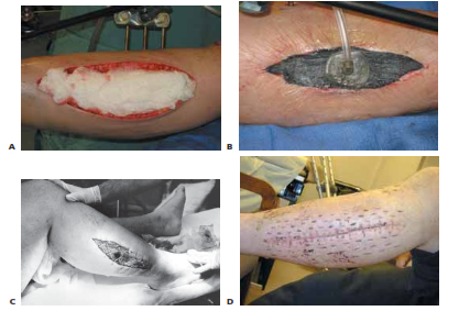 Illustration 4 for Acute Compartment Syndrome Fasciotomy: Urgent Surgical Guide