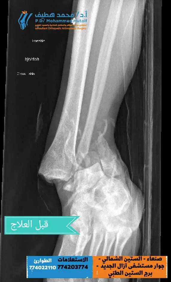 دليل أفضل دكتور عظام بصنعاء: د. هطيف.. لماذا يفضله المرضى؟