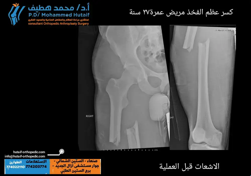 جدّد مفصلك بذكاء: سر سهولة الإصلاح بتقنية الاسمنت داخل الاسمنت