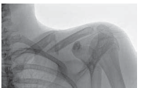 Illustration of clavicle tech fig - Dr. Mohammed Hutaif