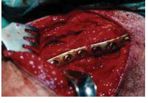 Clavicle Tech Fig: Plate Fixation for Lasting Repair