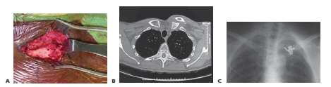Illustration 1 for Mastering Sternoclavicular Dislocation Acute Repair & Reconstruction