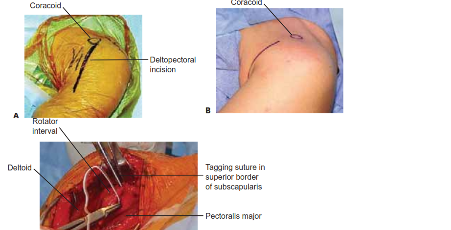Mastering Lower Lateral Brachial: Advanced Shoulder & Elbow Surgery