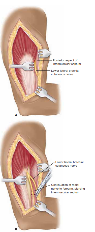 Mastering Lower Lateral Brachial: Advanced Shoulder & Elbow Surgery