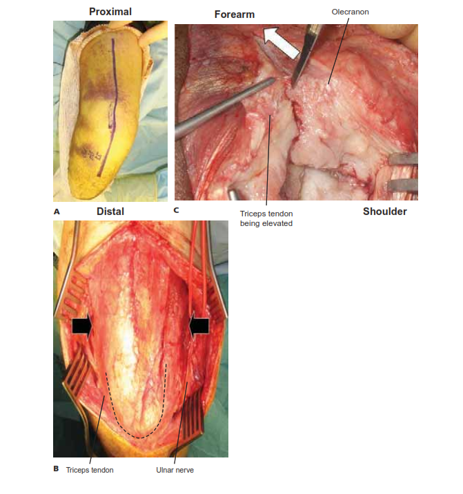 Illustration of surgical approaches elbow - Dr. Mohammed Hutaif