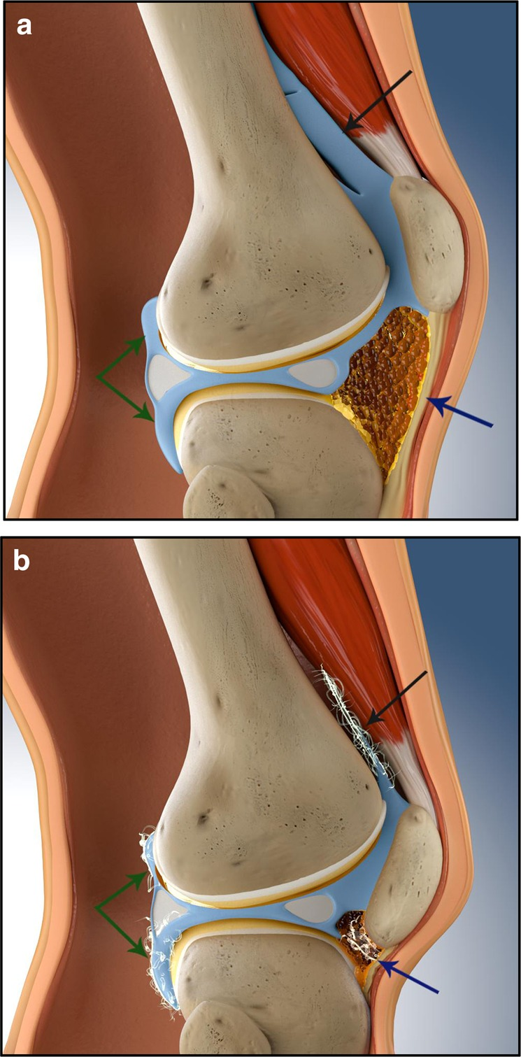 1] leading to intraarticular adhesions, excessive proliferation of ﬁbrous scar tissue, retrac tion of periarticular soft tissues and bone impingement due to intraarticular malunion; • extraarticular: quadriceps adhesions to a femoral callus, femoral aponeurosis and intermuscular septum, retraction of the muscle due to scar tissue and skin adhesions in the deeper layers. Depending on the nature of the initial injury and the treatments applied, these two components will be present in variable amounts [2]. ![