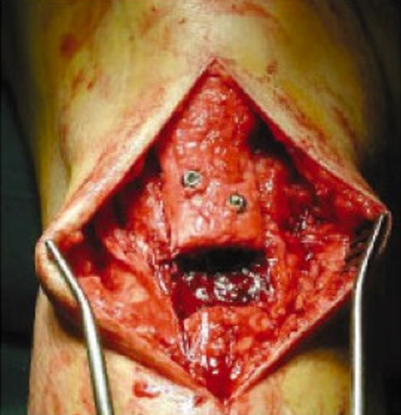 Illustration 1 for Regain Mobility: Surgical Techniques for Posttraumatic Knee Stiffness