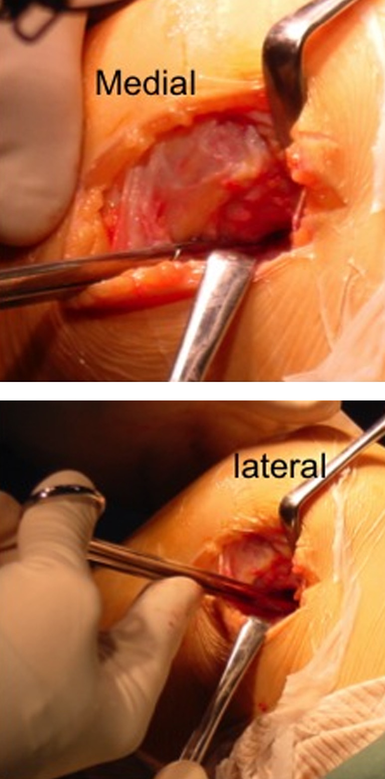 Illustration 2 for Regain Mobility: Surgical Techniques for Posttraumatic Knee Stiffness