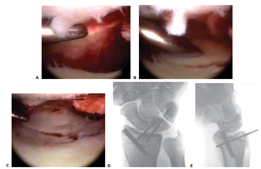 TECH FIG 1 • A.  Arthroscopic view  of the patient whose radiographs are  seen in Figure 1. The arthroscope is in the 6R portal  looking across  the wrist,  and a blunt trochar is in the 3/4 portal. The displaced radial styloid fragment is well  visualized. B.  A combination of  joysticks  inserted into the radial styloid fragment and a  trochar inserted into the 3/4  portal allows anatomic reduction of the displaced radial styloid fragment and radiocarpal joint. C.  The radial styloid fragment is anatomically reduced \(with no  residual rotation\) and stabilized. D.  PA view  demonstrating anatomic reduction to the radial styloid fragment. Headless cannulated screws  are  used, if possible, to avoid soft  tissue irritation. E.  Lateral view  showing anatomic restoration to the radial styloid fragment and restoration of the carpus in line  with the radiu