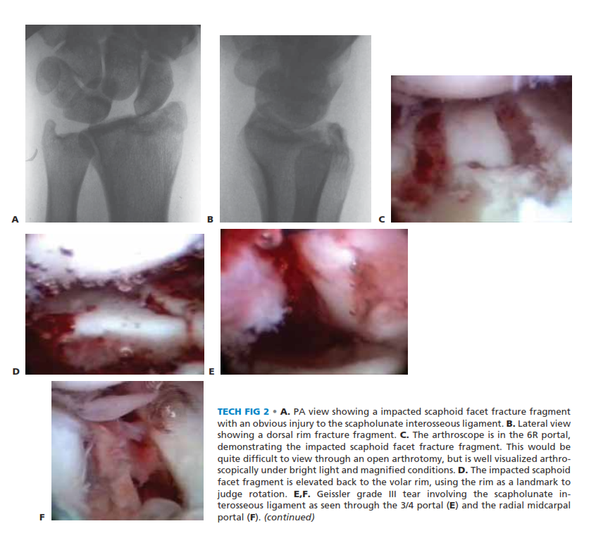 TECH FIG 1 • A.  Arthroscopic view  of the patient whose radiographs are  seen in Figure 1. The arthroscope is in the 6R portal  looking across  the wrist,  and a blunt trochar is in the 3/4 portal. The displaced radial styloid fragment is well  visualized. B.  A combination of  joysticks  inserted into the radial styloid fragment and a  trochar inserted into the 3/4  portal allows anatomic reduction of the displaced radial styloid fragment and radiocarpal joint. C.  The radial styloid fragment is anatomically reduced \(with no  residual rotation\) and stabilized. D.  PA view  demonstrating anatomic reduction to the radial styloid fragment. Headless cannulated screws  are  used, if possible, to avoid soft  tissue irritation. E.  Lateral view  showing anatomic restoration to the radial styloid fragment and restoration of the carpus in line  with the radiu