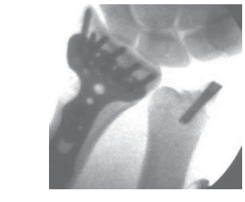 G 5 • In this case,  following reduction to the distal radius  fracture, the articular disc was  palpated and found to be lax but with no  peripheral tear. The  large ulnar styloid fragment was   reduced  with a  micro   Acutrak  screw   \(Acumed, Hillsboro, OR\).