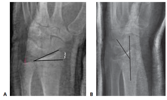 FIG 1 • Anatomy of the distal radius. The six dorsal extensor compartments at the level of the extensor retinaculum.