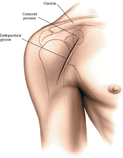 ure 1-5 Make a straight incision in the deltopectoral groove, starting at the level of the coracoid process.