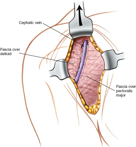 Figure 1-7 Retract the axillary incision cephalad to expose the cephalic vein and the deltopectoral groove.