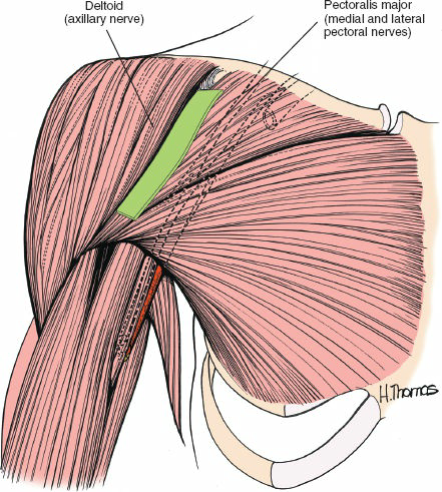 Figure 1-8 The internervous plane lies between the deltoid muscle (axillary nerve)