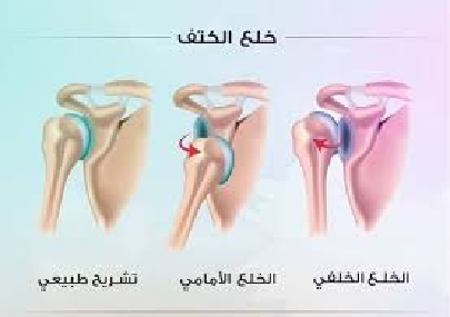 دليلك الشامل لأنواع خلع مفصل الكتف: كل ما تحتاج معرفته
