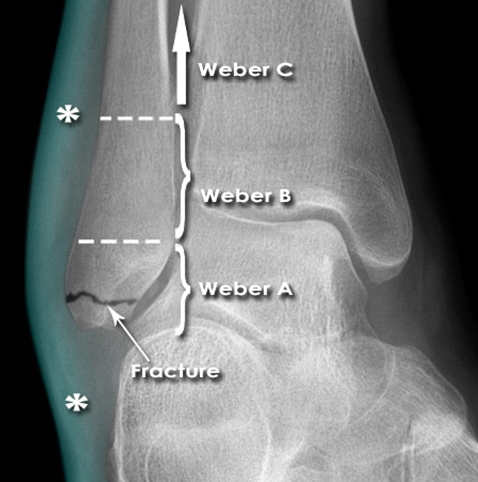 Illustration of ankle fractures dislocations - Dr. Mohammed Hutaif