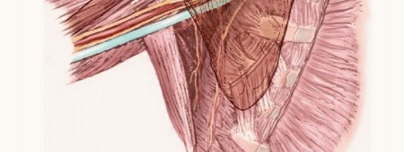 Illustration 2 for Axillary Space Exploration: Surgical Resection of Complex Tumors
