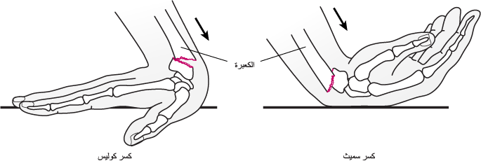 هل كسر الرسغ خطير؟