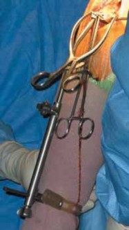 Illustration 8 for Knee Arthroplasty Unicondylar: Discover if Partial Knee Replacement is Right