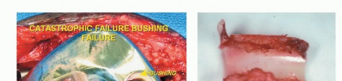 Illustration 86 for Advanced Distal Femoral Resections: Limb-Sparing Outcomes & Techniques