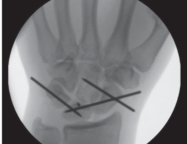FRCS Oral Exam Trauma Case: Master Perilunate Dislocation