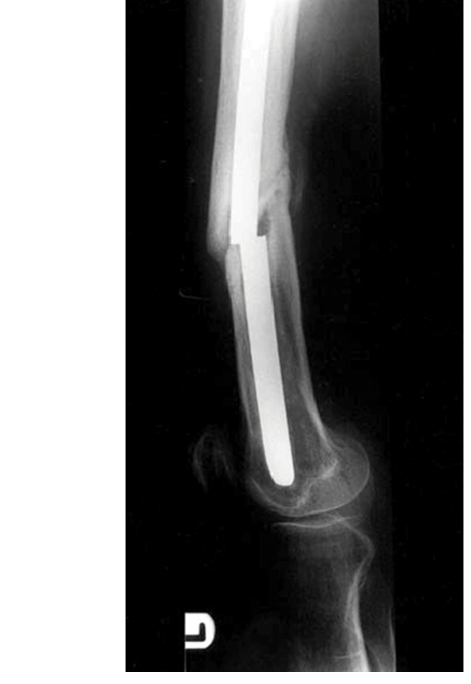 FRCS Tr & Orth: Master IM Nail Biomechanics for Oral Exam Success