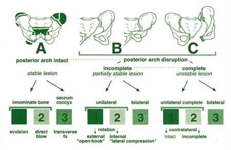 Pelvic Ring Fractures: Your Guide to Diagnosis, Treatment & Recovery