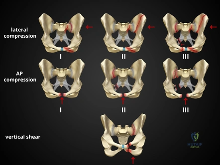Pelvic Ring Fractures: Diagnosis, Treatment, and Prognosis