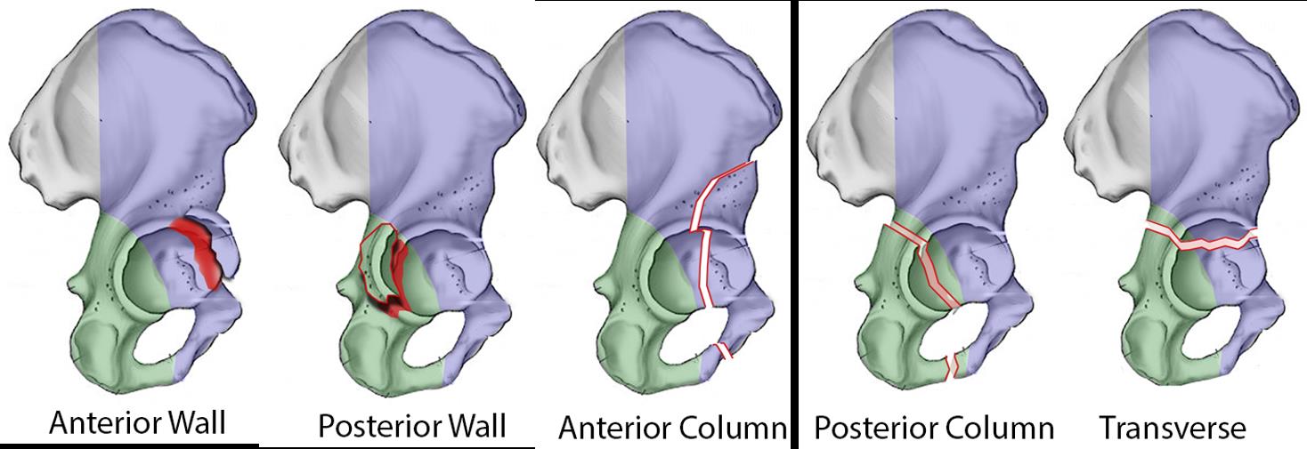 Acetabulum Fractures Diagnosis: Crucial Steps for Recovery