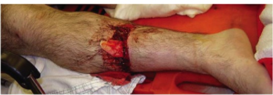 Diaphyseal Tibial Fractures: What You Must Know for Recovery