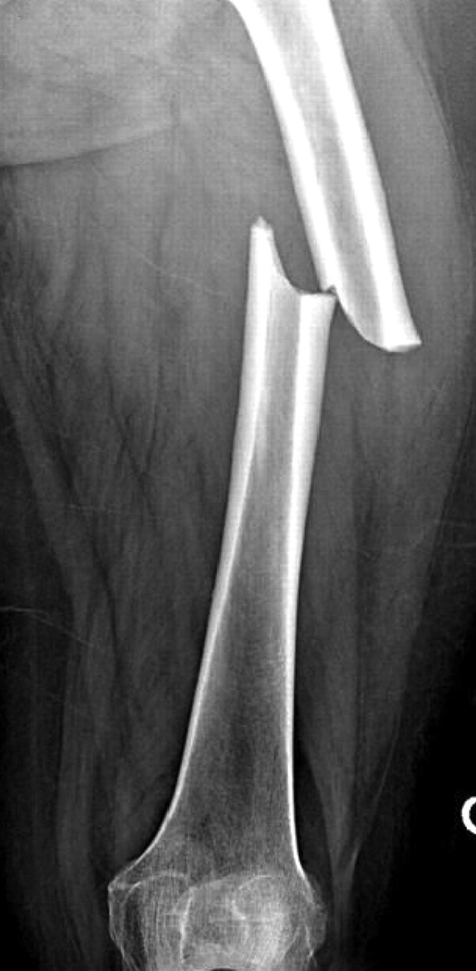 Treatment of Femoral Shaft Fractures: What You Need to Know