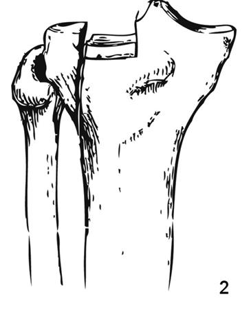 Tibial Plateau Treatment: Your Essential Guide to Recovery