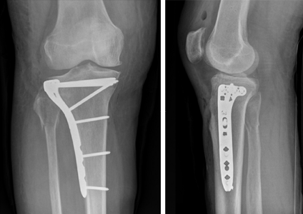 Tibial Plateau Fractures: Your Guide to Causes, Treatment & Recovery