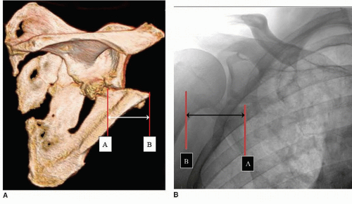 Recognize & Manage Scapula Fractures: What You Need to Know
