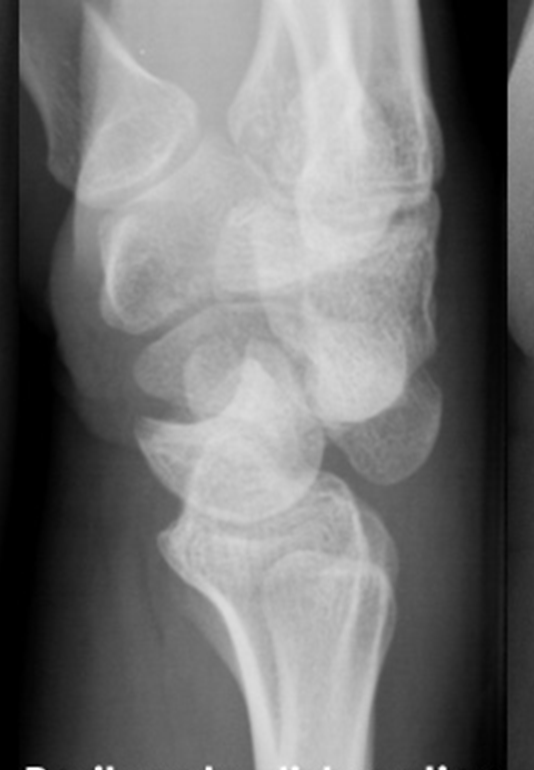 Perilunate Dislocation Trauma: Master Diagnosis & Management