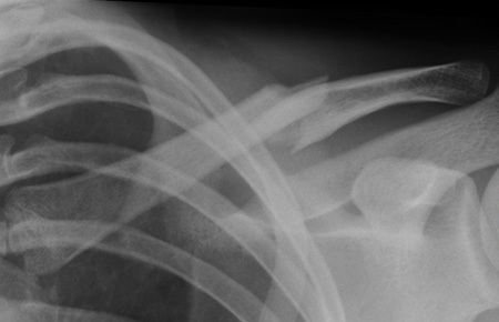 Midshaft Clavicle Fracture: Choosing the Best Treatment Path