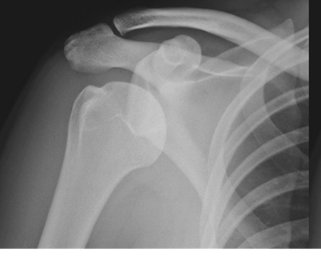 Dislocated Shoulder Exam: Show Answer Show How to Pass