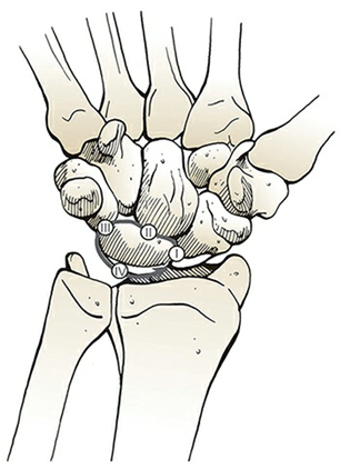 Mayfield stages of progressive perilunate instability