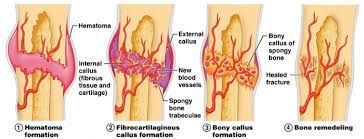 Fracture Healing Understanding: How Bones Repair & What Treatments Help