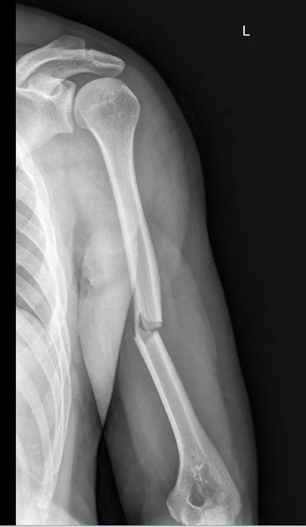 X-ray image of humeral shaft fracture