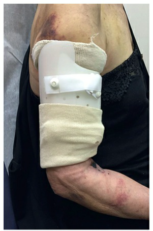 Functional brace used for a humeral shaft fracture.