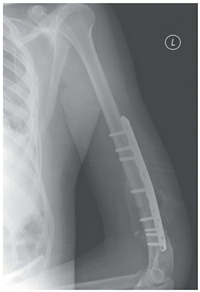 Plate and screw fixation of a distal third humeral shaft fracture.