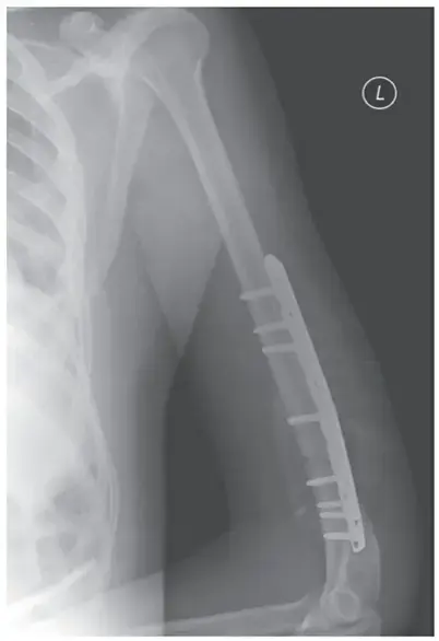 حلول متقدمة للشلل الدماغي: تنسج الورك والحق لتحسين الحركة