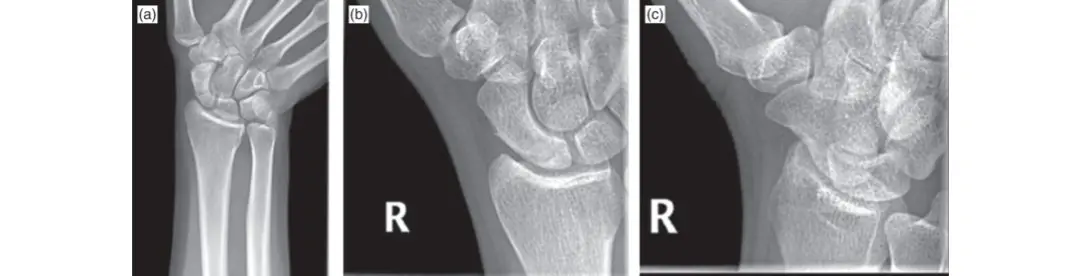 صورة توضيحية لـ كسر العظم الزورقي: دليلك الشامل للتشخيص والعلاج والتعافي بسلامة يديك مع الأستاذ الدكتور محمد هطيف