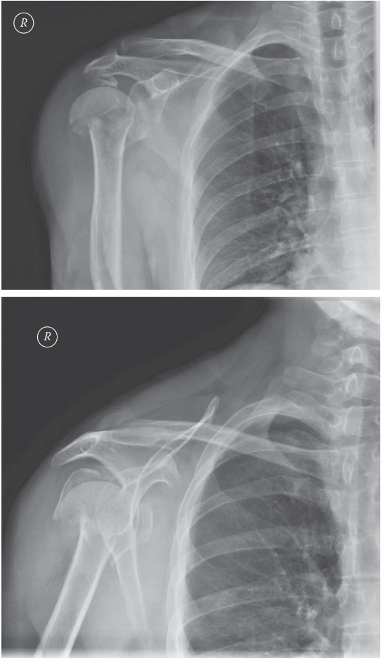 Proximal Humerus Fracture: Orthopedic MD Explains Treatment & Management