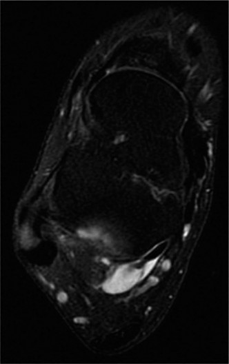 Flexor Hallucis Longus: Unlock Your Ankle Pain Mystery & Get Relief